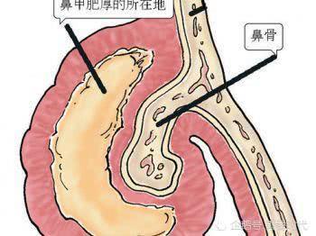 鼻炎的进行性发展不可忽视