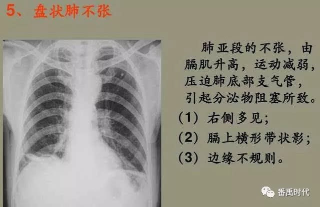 肺不张中医辩证和用药