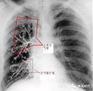 肺发育异常隶属中医禀赋不足